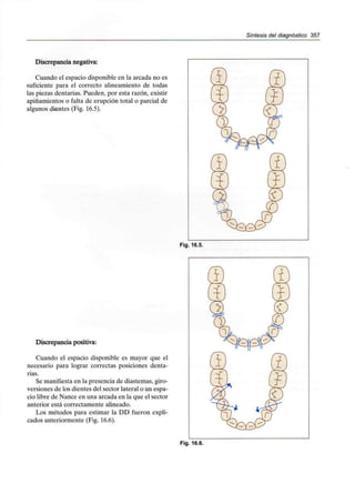 Síntesis del diagnóstico 357
Discrepancia negativa:
Cuando el espacio disponible en la arcada no es
suficiente para el correcto alineamiento de todas
las piezas dentarias. Pueden, por esta razón, existir
apiñamientos o falta de erupción total o parcial de
algunos dientes (Fig. 16.5).
Fig. 16.5.
Discrepancia positiva:
Cuando el espacio disponible es mayor que el
necesario para lograr correctas posiciones denta-
rias.
Se manifiesta en la presencia de diastemas, giro-
versiones de los dientes del sector lateral o un espa-
cio libre de Nance en una arcada en la que el sector
anterior está correctamente alineado.
Los métodos para estimar la DD fueron expli-
cados anteriormente (Fig. 16.6).
Fig. 16.6.
 