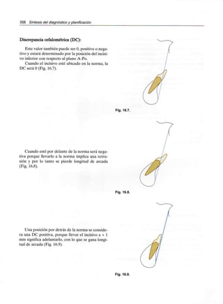 358 Síntesis del diagnóstico y planificación
Discrepancia cefalométrica (DC):
Este valor también puede ser O, positivo o nega-
tivo y estará determinado por la posición del incisi-
vo inferior con respecto al plano A-Po.
Cuando el incisivo esté ubicado en la norma, la
DC será O(Fig. 16.7).
Fig. 16.7.
Cuando esté por delante de la norma será nega-
tiva porque llevarlo a la norma implica una retru-
sión y por lo tanto se pierde longitud de arcada
(Fig. 16.8).
Fig. 16.8.
Una posición por detrás de la norma se conside-
ra una DC positiva, porque llevar el incisivo a + 1
mm significa adelantarlo, con lo que se gana longi-
tud de arcada (Fig. 16.9).
Fig. 16.9.
 