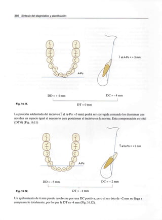 360 Síntesis del diagnóstico y planificación
A-Po
1 al A-Po = + 3 mm
DD = + 4mm
Fig. 16.11. DT = O mm
DC = - 4mm
La posición adelantada del incisivo (1 al A-Po: +3 mm) podrá ser corregida cerrando los diastemas que
nos dan un espacio igual al necesario para posicionar el incisivo en la norma. Esta compensación es total
(DT:0) (Fig. 16.11)
A-Po
1 al A-Po = + O mm
DD = - 6 mm DC = + 2 mm
Fig. 16.12. DT = - 4mm
Un apiñamiento de 6 mm puede resolverse por una DC positiva, pero al ser ésta de +2 mm no llega a
compensarlo totalmente, por lo que la DT es -4 mm (Fig .16.12).
 