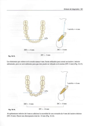 Síntesis del diagnóstico 361
DD = + 4 mm
Fig. 16.13.
DT = - 2 mm
1 al A-Po = + 4 mm
DC = - 6 mm
Los diastemas que existen en la arcada suman 4 mm. Serán utilizados para retruir un incisivo inferior
adelantado, pero no será suficiente para que éste puede ser ubicado en la norma (DT:-2 mm) (Fig. 16.13).
A-Po
DD = - 6 mm
Fig. 16.14. DT = - 14 mm
1 al A-Po = + 5 mm
DC = - 8 mm
Al apiñamiento inferior de 6 mm se adiciona la necesidad de una retrusión de 4 mm del incisivo inferior
(DC:-8 mm). Hacen una discrepancia total de -14 mm (Fig. 16.14).
 