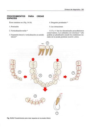 Síntesis del diagnóstico 363
PROCEDIMIENTOS PARA CREAR
ESPACIOS
Éstos consisten en: (Fig.16.16).
1. Protrusión
2. Verticalización molar *
3. Expansión lateral o verticalización en sentido
lateral *
4. Desgastes proximales *
5. Las extracciones
1-2-3 y 4 Son los denominados procedimientos
conservadores. Los señalados con asteriscos * sólo
podrán ser planificados cuando las condiciones ini-
ciales de la arcada permitan recurrir a éstos.
0
Fig. 16.16: Procedimientos para crear espacios en la arcada inferior.
 