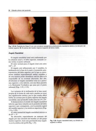 38 Estudio clínico del paciente
Fig. 1.31.A: Paciente de Clase III con una curvatura nasogeniana prácticamenteinexistentedebido a la retrusión del
maxilar superior. B: El avance del maxilar mejora el aspecto del tercio medio.
Ángulo Nasolabial
El ángulo nasolabial total está conformado por
la columela nasal y el labio superior, tomando co-
mo vértice el punto subnasal.
El valor normal para el ángulo total está entre
102° +- 8°.
El ángulo está influenciado por 2 variables, la
inclinación de la base de la nariz y la posición ante-
roposterior del labio superior, por lo que es conve-
niente analizar separadamente ambas variables y
de esta manera poder identificar cuál de ellas es la
responsable de su eventual alteración. Por ello,
dividiremos al ángulo nasolabial total en 2 partes:
una superior y otra inferior, con una línea paralela
a la Horizontal Verdadera que pasa por el punto
subnasal (Figs. 1.32 y 1.33).
Las variantes de la inclinación de la base nasal,
propias de la forma de cada nariz, pueden no tener
una significación estética, por lo que resulta difícil
hablar de normas para la parte superior del ángulo
nasolabial, cuyo promedio oscila entre los 15°y 20°.
Sí destacaremos el estudio del ángulo nasolabial
inferior, que tiene relación con la posición del labio
superior y por consiguiente, con la posición sagital
del maxilar superior y los incisivos superiores (Figs.
1.34 y 1.35).
El valor normal del ángulo nasolabial inferior es
de 85° +- 5°.
Su alteración, especialmente un aumento del
ángulo por una retrusión del maxilar y/o del grupo
incisivo superior, tiene una gravitación muy negati-
va en la estética del perfil (Fig. 1.35).
5
Fig. 1.32: Ángulo nasolabialtotal y su división en
superior e inferior.
 