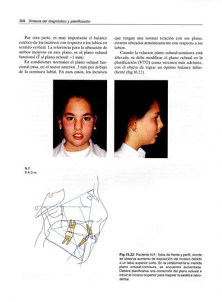 368 Síntesis del diagnóstico y planificación
Por otra parte, es muy importante el balance
estético de los incisivos con respecto a los labios en
sentido vertical. La referencia para la ubicación de
ambos incisivos en este plano, es el plano oclusal
funcional (1 al plano oclusal: +1 mm).
En condiciones normales el plano oclusal fun-
cional pasa, en el sector anterior, 3 mm por debajo
de la comisura labial. En esos casos, los incisivos
que tengan una normal relación con ese plano,
estarán ubicados armónicamente con respecto a los
labios.
Cuando la relación plano oclusal-comisura está
alterada, se debe modificar el plano oclusal en la
planificación (VTO) como veremos más adelante,
con el objeto de lograr un óptimo balance labio-
diente (fig.16.22).
N.F.
9A3 m.
Fig.16.22: Paciente N.F.: fotos de frente y perfil, donde
se observa aumento de exposición del incisivo debido
a un labio superior corto. En la cefalometría la medida
plano oclusal-comisura, se encuentra aumentada.
Deberá planificarse una corrección del plano oclusal e
intruir el incisivo superior para mejorar la estética labio-
dental.
 
