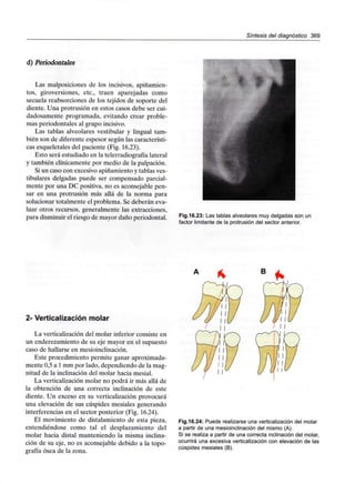 Síntesis del diagnóstico 369
d) Periodontales
Las malposiciones de los incisivos, apiñamien-
tos, giroversiones, etc., traen aparejadas como
secuela reabsorciones de los tejidos de soporte del
diente. Una protrusión en estos casos debe ser cui-
dadosamente programada, evitando crear proble-
mas periodontales al grupo incisivo.
Las tablas alveolares vestibular y lingual tam-
bién son de diferente espesor según las característi-
cas esqueletales del paciente (Fig. 16.23).
Esto será estudiado en la telerradiografía lateral
y también clínicamente por medio de la palpación.
Si un caso con excesivo apiñamiento y tablas ves-
tibulares delgadas puede ser compensado parcial-
mente por una DC positiva, no es aconsejable pen-
sar en una protrusión más allá de la norma para
solucionar totalmente el problema. Se deberán eva-
luar otros recursos, generalmente las extracciones,
para disminuir el riesgo de mayor daño periodontal. Fig.16.23: Las tablas alveolares muy delgadas son un
factor limitante de la protrusión del sector anterior.
2- Verticalización molar
La verticalización del molar inferior consiste en
un enderezamiento de su eje mayor en el supuesto
caso de hallarse en mesioinclinación.
Este procedimiento permite ganar aproximada-
mente 0,5a 1mm por lado, dependiendo de la mag-
nitud de la inclinación del molar hacia mesial.
La verticalización molar no podrá ir más allá de
la obtención de una correcta inclinación de este
diente. Un exceso en su verticalización provocará
una elevación de sus cúspides mesiales generando
interferencias en el sector posterior (Fig. 16.24).
El movimiento de distalamiento de esta pieza,
entendiéndose como tal el desplazamiento del
molar hacia distal manteniendo la misma inclina-
ción de su eje, no es aconsejable debido a la topo-
grafía ósea de la zona.
Fig.16.24: Puede realizarse una verticalización del molar
a partir de una mesioinclinación del mismo (A).
Si se realiza a partir de una correcta inclinación del molar,
ocurrirá una excesiva verticalización con elevación de las
cúspides mesiales (B).
 