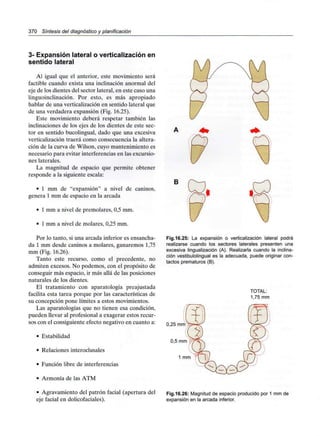370 Síntesis del diagnóstico y planificación
3- Expansión lateral o verticalizaciónen
sentido lateral
Al igual que el anterior, este movimiento será
factible cuando exista una inclinación anormal del
eje de los dientes del sector lateral, en este caso una
linguoinclinación. Por esto, es más apropiado
hablar de una verticalización en sentido lateral que
de una verdadera expansión (Fig. 16.25).
Este movimiento deberá respetar también las
inclinaciones de los ejes de los dientes de este sec-
tor en sentido bucolingual, dado que una excesiva
verticalización traerá como consecuencia la altera-
ción de la curva de Wilson, cuyo mantenimiento es
necesario para evitar interferencias en las excursio-
nes laterales.
La magnitud de espacio que permite obtener
responde a la siguiente escala:
• 1 mm de "expansión" a nivel de caninos,
genera 1 mm de espacio en la arcada
• 1 mm a nivel de premolares, 0,5 mm.
• 1 mm a nivel de molares, 0,25mm.
Por lo tanto, si una arcada inferior es ensancha-
da 1 mm desde caninos a molares, ganaremos 1,75
mm (Fig. 16.26).
Tanto este recurso, como el precedente, no
admiten excesos. No podemos, con el propósito de
conseguir más espacio, ir más allá de las posiciones
naturales de los dientes.
El tratamiento con aparatología preajustada
facilita esta tarea porque por las características de
su concepción pone límites a estos movimientos.
Las aparatologías que no tienen esa condición,
pueden llevar al profesional a exagerar estos recur-
sos con el consiguiente efecto negativo en cuanto a:
• Estabilidad
• Relaciones interoclusales
• Función libre de interferencias
• Armonía de lasATM
• Agravamiento del patrón facial (apertura del
eje facial en dolicofaciales).
B
Fig.16.25: La expansión o verticalización lateral podrá
realizarse cuando los sectores laterales presenten una
excesiva lingualización (A). Realizarla cuando la inclina-
ción vestibulolinguales la adecuada, puede originar con-
tactos prematuros(B).
TOTAL:
1,75 mm
Fig.16.26: Magnitud de espacio producido por 1 mm de
expansión en la arcada inferior.
 