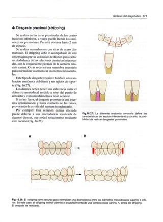 Síntesis del diagnóstico 371
4- Desgaste proximal (stripping)
Se realiza en las caras proximales de los cuatro
incisivos inferiores, a veces puede incluir los cani-
nos y los premolares. Permite obtener hasta 2 mm
de espacio.
Se realiza manualmente con tiras de acero dia-
mantado. El stripping debe ir acompañado de una
observación previa del índice de Bolton para evitar
un desbalance de las relaciones dentarias interarca-
das, con la consecuente pérdida de la correcta rela-
ción canina. Otras veces es una maniobra necesaria
para normalizar o armonizar diámetros mesiodista-
les.
Este tipo de desgaste requiere también una eva-
luación anatómica del diente y sus tejidos de sopor-
te (Fig. 16.27).
Los dientes deben tener una diferencia entre el
diámetro mesiodistal medido a nivel del punto de
contacto y el mismo diámetro a nivel cervical.
Si así no fuera, el desgaste provocaría una exce-
siva aproximación y hasta contacto de las raíces,
provocando la atrofia del septum interdentario.
Por ejemplo: Una relación canina alterada
puede deberse a una macrodoncia localizada de
algunos dientes, que podrá solucionarse mediante
este recurso (Fig. 16.28).
Fig.16.27: La diferente anatomía coronaria define las
características del septum interdentarioy con ello, la posi-
bilidad de realizar desgastesproximales.
B
Fig.16.28: El stripping como recurso para normalizar una discrepancia entre los diámetros mesiodístales superior e infe-
rior. En este caso, el stripping inferior permite el establecimientode una correcta clase canina. A: antes del stripping.
B: después de realizado.
 