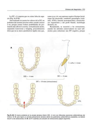 Síntesis del diagnóstico 373
La DT = O,expresa que no existe falta de espa-
cio (Fig. 16.29 B).
Aun teniendo en cuenta los valores de la DT, no
podemos dar normas precisas sobre cuando extraer
o no, porque restan evaluar posibilidades de pro-
trusión más allá de la norma, verticalización molar,
expansión transversal y stripping, procedimientos
éstos que no se atan a parámetros rígidos sino que,
como ya se vio, son opciones según el biotipo facial,
etapa del desarrollo, condición gnatológica (oclu-
sión, ATM y función neuromuscular), característi-
cas esqueletales y del perfil blando, morfología
dentaria, etc.
Resumiendo, se recurrirá a las extracciones,
cuando los métodos conservadores no sean sufi-
cientes para solucionar una DT negativa, porque
1 - A-Po = + 4 mm
DD = - 4mm DC = - 6 mm
DT = -10 mm (extracciones)
Fig.16..29: El mismo problema en la arcada dentaria inferior (DD: -4 mm) con diferentes posiciones cefalométricas del
incisivo. En A: para lograr un correcto alineamiento dentario dentro de parámetros cefalométricos aceptables, se deberá
recurrir a las extracciones.En B: la DT Oplantea una solución sin extracciones (página siguiente).
 