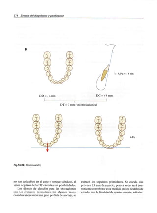 374 Síntesis del diagnóstico y planificación
B
1 - A-Po = - 1 mm
DD = - 4 mm DC = + 4 mm
DT = Omm (sin extracciones)
A-Po
Fig.16.29: (Continuación)
no son aplicables en el caso o porque siéndolo, el
valor negativo de la DT exceda a sus posibilidades.
Los dientes de elección para las extracciones
son los primeros premolares. En algunos casos,
cuando es necesario una gran pérdida de anclaje, se
extraen los segundos premolares. Se calcula que
proveen 15 mm de espacio, pero a veces será con-
veniente corroborar esta medida en los modelos de
estudio con la finalidad de ajustar nuestro cálculo.
 