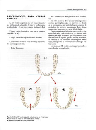 Síntesis del diagnóstico 375
PROCEDIMENTOS PARA CERRAR
ESPACIOS
La DT positiva significa que hay exceso de espa-
cio en la arcada ubicando el incisivo en la norma
cefalométrica (+1 mm con respecto al plano A-Po).
Existen varias alternativas para cerrar los espa-
cios (Fig. 16.30):
• Dejar los incisivos por detrás de la norma.
• Colocar los incisivos en la norma ymesializar
los sectores posteriores.
• Dejar diastemas.
La combinación de algunas de estas alternati-
vas.
En estos casos se debe evaluar el compromiso
estético que implica dejar los incisivos por detrás
de la norma como así también la conveniencia de
mesializar los sectores posteriores. Esto último
puede traer aparejado un cierre del eje facial.
En patrones braquifaciales severos pueden estar
contraindicadas estas maniobras, por lo que suele
optarse por dejar diastemas que, lógicamente esta-
rán ubicados en lugares que no afecten la estética,
la fonación o las relaciones intercuspales. Otras
veces, se requerirá el auxilio de la odontología res-
tauradora.
Los casos de DT positiva suelen corresponder a
microdonciasgeneralizadas.
Fig.16.30: Una DT positiva puede solucionarse de 2 maneras:
A: Llevando los incisivos por detrás de la norma.
B: Mesializando los sectoresposteriores.
 
