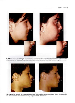 Estética facial 39
Fig. 1.33: Un mismo valor del ángulo nasolabial total puede corresponder a pacientes con características morfológicas total-
mente dispares, que se describen acertadamente a través de las medidas de los ángulos nasolabial superior e inferior.
Fig. 1.34: Cambio favorable del ángulo nasolabial inferior en un paciente ortodóncico portador de una biprotrusión den-
taria, donde se han realizado 4 extracciones y una gran retrusión de inicisivos.
 
