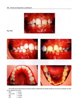 380 Síntesis del diagnóstico y planificación
Fig. 16.34.
El estudio de la discrepancia dentaria inferior utilizando las tablas de Moyers da como resultado un défi-
cit de espacio de 6 mm.
DD = -6 mm
1 al A-Po = -1mm
DC = +4 mm
DT = -2 mm
 