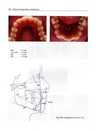 384 Síntesis del diagnóstico y planificación
• m
DD
1 al A-Po
DC
DT
= -6 mm
= +4 mm
= -6 mm
= -12 mm
+1 mm
Fig. 16.37: Cefalograma del caso M. V. B.
 