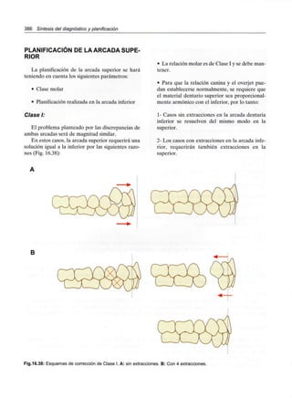 386 Síntesis del diagnóstico y planificación
PLANIFICACIÓN DE LA ARCADA SUPE-
RIOR
La planificación de la arcada superior se hará
teniendo en cuenta los siguientes parámetros:
• Clase molar
• Planificaciónrealizada en la arcada inferior
Clase I:
El problema planteado por las discrepancias de
ambas arcadas será de magnitudsimilar.
En estos casos, la arcada superior requerirá una
solución igual a la inferior por las siguientes razo-
nes (Fig. 16.38):
• La relación molar es de Clase I y se debe man-
tener.
• Para que la relación canina y el overjet pue-
dan establecerse normalmente, se requiere que
el material dentario superior sea proporcional-
mente armónico con el inferior, por lo tanto:
1- Casos sin extracciones en la arcada dentaria
inferior se resuelven del mismo modo en la
superior.
2- Los casos con extracciones en la arcada infe-
rior, requerirán también extracciones en la
superior.
B
Fig.16.38: Esquemas de corrección de Clase I. A: sin extracciones. B: Con 4extracciones.
 