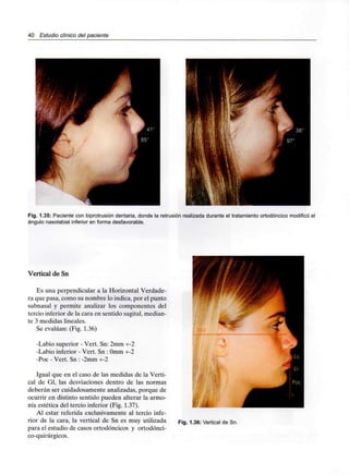 40 Estudio clínico del paciente
Fig. 1.35: Paciente con biprotrusión dentaria, donde la retrusión realizada durante el tratamiento ortodóncico modificó el
ángulo nasolabial inferior en forma desfavorable.
Vertical de Sn
Es una perpendicular a la Horizontal Verdade-
ra que pasa, como su nombre lo indica, por el punto
subnasal y permite analizar los componentes del
tercio inferior de la cara en sentido sagital, median-
te 3 medidas lineales.
Se evalúan: (Fig. 1.36)
-Labio superior - Vert. Sn: 2mm +-2
-Labio inferior - Vert. Sn : Omm +-2
-Poc - Vert. Sn : -2mm +-2
Igual que en el caso de las medidas de la Verti-
cal de Gl, las desviaciones dentro de las normas
deberán ser cuidadosamente analizadas, porque de
ocurrir en distinto sentido pueden alterar la armo-
nía estética del tercio inferior (Fig. 1.37).
Al estar referida exclusivamente al tercio infe-
rior de la cara, la vertical de Sn es muy utilizada
para el estudio de casos ortodóncicos y ortodónci-
co-quirúrgicos.
í> *
Fig. 1.36: Vertical de Sn.
 