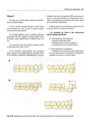 Síntesis del diagnóstico 387
Clase II:
En estos casos, la DT plantea diferentes proble-
mas en ambas arcadas.
• En la arcada dentaria inferior la DT puede
estar cercana al O, por lo que en general puede
resolverse sin extracciones.
• La arcada superior, por el contrario, plantea
problemas de DT negativa, porque puede estar
protruida, tener apiñamientos o ambas cosas a la
vez.
La solución de esta DT negativa superior debe
ser buscada entre (Fig. 16.39):
1-Los métodos conservadores que permiten
ganar espacio en la arcada superior, (rotación distal
de los molares, expansión, distalamiento) y la posi-
bilidad de un efecto ortopédico (FEO anteroposte-
rior) en casos de pacientes en crecimiento con el
objeto de producir una corrección de la clase molar
por crecimiento diferencial.
2-Recurriendo a las extracciones superiores con
el fin de obtener el espacio necesario.
l.La mecánica de Clase II sin extracciones
puede realizarse mediante:
a) Procedimientos ortodóncicos:
• rotación distal del molar
• distalamiento del molar superior
• mesialización de la arcada inferior
b) Procedimientos ortopédicos:
• inhibición de crecimiento del maxilar supe-
rior con el fin de que el crecimiento mandibular
equilibre las bases en sentido sagital
Fig.16.39: Esquemas de corrección de Clase II. A: sin extracciones. B: con dos extracciones superiores.
 
