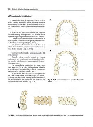 388 Síntesis del diagnóstico y planificación
a) Procedimientos ortodóncicos:
- La rotación distal de los molares superiores se
utiliza cuando la posición inicial del molar muestra
una rotación mesial. Para determinar esto, se reali-
zan las siguientes observaciones en el modelo supe-
rior:
- Se traza una línea que uniendo las cúspides
distovestibular y mesiopalatina del primer molar
superior se prolongue hasta la hemiarcada opuesta.
Cuando el molar tiene una rotación normal, la
prolongación de la línea debe pasar por la vertien-
te distal del canino opuesto (Fig. 16.40 A).
En los casos de rotación mesial lo hará a la
altura de premolares, y en casos severos hasta en la
zona de los molares (Fig. 16.40 B).
- También se observan lastroneras mesialesdel
primer molar:
Cuando exista rotación mesial, la tronera
palatina se verá mucho más amplia que la vestibu-
lar, siendo prácticamente iguales cuando la posi-
ción es correcta.
La aparatología preajustada es muy eficaz
para la corrección de estas malposiciones, más aún
si se adicionan ciertos auxiliares (barra transpalati-
na, quad-hélix, palatal expander, etc.).
Si se evalúan las posiciones previa y posterior
a la rotación del molar desde la perspectiva lateral,
veremos que la rotación distal produce el efecto de
un distalamiento. Se observará con claridad un
retroceso de su cara mesial (Fig. 16.41).
B
Fig.16.40: A: Molares con correcta rotación. B: rotación
mesial.
Fig.16.41: La rotación distal del molar permite ganar espacio y corregir la relación de Clase II de los sectores laterales.
 