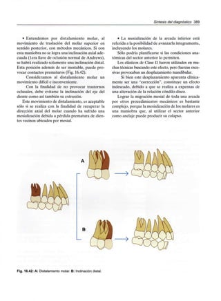 Síntesis del diagnóstico 389
• Entendemos por distalamiento molar, al
movimiento de traslación del molar superior en
sentido posterior, con métodos mecánicos. Si con
esta maniobra no se logra una inclinación axial ade-
cuada (lera llave de oclusión normal de Andrews),
se habrá realizado solamente una inclinación distal.
Esta posición además de ser inestable, puede pro-
vocar contactos prematuros (Fig. 16.42).
Consideramos al distalamiento molar un
movimiento difícil e inconveniente.
Con la finalidad de no provocar trastornos
oclusales, debe evitarse la inclinación del eje del
diente como así también su extrusión.
Este movimiento de distalamiento, es aceptable
sólo si se realiza con la finalidad de recuperar la
dirección axial del molar cuando ha sufrido una
mesialización debida a pérdida prematura de dien-
tes vecinos ubicados por mesial.
• La mesialización de la arcada inferior está
referida a la posibilidad de avanzarla íntegramente,
incluyendo los molares.
Sólo podría planificarse si las condiciones ana-
tómicas del sector anterior lo permiten.
Los elásticos de Clase II fueron utilizados en mu-
chas técnicas buscando este efecto, pero fuerzas exce-
sivas provocaban un desplazamiento mandibular.
Si bien este desplazamiento aparenta clínica-
mente ser una "corrección", constituye un efecto
indeseado, debido a que se realiza a expensas de
una alteración de la relación cóndilo-disco.
Lograr la migración mesial de toda una arcada
por otros procedimientos mecánicos es bastante
complejo, porque la mesialización de los molares es
una maniobra que, al utilizar el sector anterior
como anclaje puede producir su colapso.
B
Fig. 16.42: A: Distalamiento molar. B: Inclinacióndistal.
 