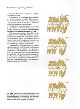 392 Síntesis del diagnóstico y planificación
Podríamos denominar a éstos "casos de Clase
II con 4 extracciones".
El propósito de las extracciones inferiores apun-
ta a alcanzar una mayor retrusión del sector ante-
rior. Indudablemente estos casos terminarán con
Clase I molar, aunque no sea éste en realidad el
propósito de las extracciones inferiores.
Para planificar cuatro extracciones en un caso
de Clase II debe analizarse cuidadosamente la cla-
se molar, teniendo en cuenta que todo caso tratado
con cuatro extracciones debe finalizar en Clase I.
Si inicialmente presenta una Clase II de cúspide
completa, alcanzar la Clase I molar habiendo reali-
zado las cuatro extracciones requerirá una mesiali-
zación del molar inferior prácticamente igual al
espacio creado con la extracción del premolar y no
se podrá retruir el incisivo.Por lo tanto, pasa a ser
una maniobra que complica el tratamiento
La terapia de cuatro extracciones sólo estaría
indicada en casos de Clase II cuando presenten una
relación molar cúspide a cúspide, y con apiñamien-
tos inferiores o con una posición avanzada del 1 al
A-Po y se indique una recolocación que requiera
un espacio que sólo las extracciones pueden gene-
rar. Pero siempre deberemos tener la precaución
de planificar una mesialización de los molares infe-
riores que permita establecer la Clase I molar al
final del tratamiento (Fig. 16.44).
A-Po
Fig. 16.44: Planificación de cuatro extracciones en una
Clase II cúspide a cúspide. Las extraccionesinferiores son
necesarias para retruir el incisivo inferior, pero deben per-
mitir la mesialización de los molares inferiores para esta-
blecer una Clase I molar al finalizar eltratamiento.
A-Po
A-Po
A-Po
 