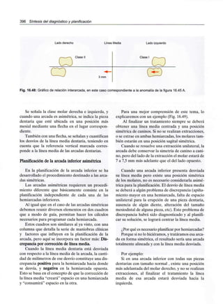 396 Síntesis del diagnóstico y planificación
Lado derecho Línea Media Lado izquierdo
Clase I Clase I
3 mm
Fig. 16.48: Gráfico de relación interarcada, en este caso correspondiente a la anomalía de la figura 16.45 A.
Se señala la clase molar derecha e izquierda, y
cuando una arcada es asimétrica, se indica la pieza
dentaria que esté ubicada en una posición más
mesial mediante una flecha en el lugar correspon-
diente.
También con una flecha, se señalan y cuantifican
los desvíos de la línea media dentaria, teniendo en
cuenta que la referencia vertical marcada corres-
ponde a la línea media de las arcadas dentarias.
Planificación de la arcada inferior asimétrica
En la planificación de la arcada inferior se ha
desarrollado el procedimiento destinado a las arca-
das simétricas.
Las arcadas asimétricas requieren un procedi-
miento diferente que básicamente consiste en la
planificación independiente de cada una de las
hemiarcadas inferiores.
Al igual que en el caso de las arcadas simétricas
debemos reunir diversos elementos en dos cuadros
que a modo de guía, permitan hacer los cálculos
necesarios para programar cada hemiarcada.
Estos cuadros son similares al ya visto, con una
columna que detalla la serie de maniobras clínicas
y factores que influyen en la planificación de la
arcada, pero aquí se incorpora un factor más: Dis-
crepancia por corrección de línea media.
Cuando la línea media dentaria está desviada
con respecto a la línea media de la arcada, la canti-
dad de milímetros de ese desvío constituye una dis-
crepancia positiva para la hemiarcada hacia donde
se desvía, y negativa en la hemiarcada opuesta.
Esto se basa en el concepto de que la corrección de
la línea media "creará" espacio en una hemiarcada
y "consumirá" espacio en la otra.
Para una mejor comprensión de este tema, lo
explicaremos con un ejemplo (Fig. 16.49).
Al finalizar un tratamiento siempre se deberá
obtener una línea media centrada y una posición
simétrica de caninos. Si no se realizan extracciones,
o se extrae en ambas hemiarcadas, los molares tam-
bién estarán en una posición sagital simétrica.
Cuando se resuelve una extracción unilateral, la
arcada debe conservar la simetría de canino a cani-
no, pero del lado de la extracción el molar estará de
7 a 7,5 mm más adelante que el del lado opuesto.
Cuando una arcada inferior presenta desviada
su línea media pero existe una posición simétrica
de los molares, no es necesario considerarla asimé-
trica para la planificación. El desvío de línea media
se deberá a algún problema de discrepancia (apiña-
miento mayor en una hemiarcada, falta de espacio
unilateral para la erupción de una pieza dentaria,
ausencia de algún diente, alteración del tamaño
mesiodistal de alguna pieza, etc). Este problema de
discrepancia habrá sido diagnosticado y al planifi-
car su solución, se logrará centrar la línea media.
¿Por qué esnecesario planificar por hemiarcadas?
Porque si no lo hiciéramos, y tratáramos esa arca-
da en forma simétrica, el resultado sería una arcada
totalmente alineada y con la línea media desviada.
Por ejemplo:
Si en una arcada inferior con todas sus piezas
dentarias con tamaño normal , existe una posición
más adelantada del molar derecho, y no se realizan
extracciones, al finalizar el tratamiento la línea
media de esa arcada estará desviada hacia la
izquierda.
 