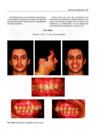 Síntesis del diagnóstico 397
En el mismo caso, si se realizaran extracciones y
el movimiento de cierre de los espacios es igual del
lado derecho que del lado izquierdo, obtendríamos
el mismo resultado.
Quiere decir que, para que obtengamos una
línea media correctamente centrada cuando en una
arcada las posiciones sagitales de los molares son
asimétricas, la planificación de una hemiarcada
necesariamente será diferente a la de la otra.
Caso clínico
Paciente: A. M. - 27 años - Sexo masculino
Fig. 16.49: PacienteA.M. Fotografías de cara y boca.
 
