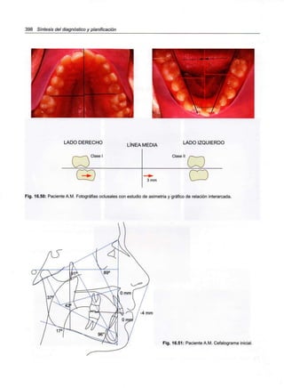 398 Síntesis del diagnóstico y planificación
LADO DERECHO
,————e I
V/-^y
LÍNEA MEDIA LADO IZQUIERDO
Clase I
3 mm O
——
Fig. 16.50: Paciente A.M.Fotografías oclusales con estudio de asimetría y gráfico de relación interarcada.
/ -4 mm
Fig. 16.51: Paciente A.M.Cefalograma inicial.
 