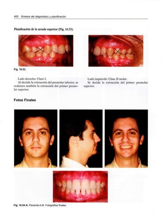 400 Síntesis del diagnóstico y planificación
Planificación de la arcada superior (Fig. 16.53).
Fig. 16.53.
Lado derecho: Clase I.
Al decidir la extracción del premolar inferior, se
realizara también la extracción del primer premo-
lar superior.
Lado izquierdo: Clase II molar.
Se decide la extracción del primer premolar
superior.
Fotos Finales
Fig. 16.54 A: PacienteA.M. Fotografías finales.
 