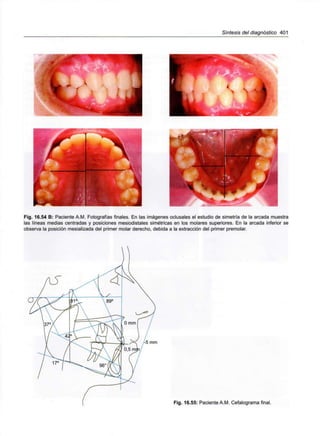 Síntesis del diagnóstico 401
Fig. 16.54 B: Paciente A.M. Fotografías finales. En las imágenes oclusales el estudio de simetría de la arcada muestra
las líneas medias centradas y posiciones mesiodistales simétricas en los molares superiores. En la arcada inferior se
observa la posición mesializada del primer molar derecho, debida a la extracción del primer premolar.
f-5 mm
Fig. 16.55: Paciente A.M. Cefalograma final.
 