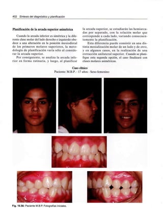 402 Síntesis del diagnóstico y planificación
Planificación de la arcada superior asimétrica
Cuando la arcada inferior es simétrica y la dife-
rente clase molar del lado derecho e izquierdo obe-
dece a una alteración en la posición mesiodistal
de los primeros molares superiores, la meto-
dología de planificación varía sólo al conside-
rar la arcada superior.
Por consiguiente, se analiza la arcada infe-
rior en forma rutinaria, y luego, al planificar
la arcada superior, se estudiarán las hemiarca-
das por separado, con la relación molar que
corresponde a cada lado, variando consecuen-
temente la planificación.
Esta diferencia puede consistir en una dis-
tinta mesialización molar de un lado y de otro,
y en algunos casos, en la realización de una
extracción unilateral superior. Cuando seplani-
fique esta segunda opción, el caso finalizará con
clases molares asimétricas.
Caso clínico
Paciente: M.B.P. -17 años - Sexo femenino
Fig. 16.56: Paciente M.B.P. Fotografías iniciales.
 