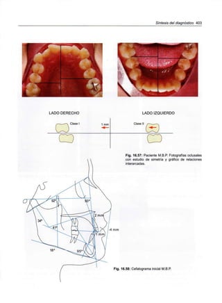 Síntesis del diagnóstico 403
LADO DERECHO
Clase I
LADO IZQUIERDO
1 mm Clase I
Fig. 16.57: Paciente M.B.P. Fotografías oclusales
con estudio de simetría y gráfico de relaciones
interarcadas.
-4 mm
Fig. 16.58: Cefalograma inicial M.B.P.
 