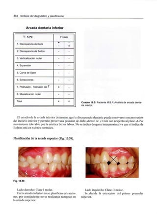 404 Síntesis del diagnóstico y planificación
Arcada dentaria inferior
1 - A-Po
1. Discrepanciadentaria
2. Discrepanciade Bolton
3. Verticalización molar
4. Expansión
5. Curva de Spee
6. Extracciones
7. Protrusión - Retrusióndel 1
8. Mesializaciónmolar
Total
+1 mm
+
-
-
-
-
-
4
-
4
4
-
-
-
-
-
-
-
4 Cuadro 16.5: Paciente M.B.P. Análisis de arcada denta-
ria inferior.
El estudio de la arcada inferior determina que la discrepancia dentaria puede resolverse con protrusión
del incisivo inferior y permite prever una posición de dicho diente de +3 mm con respecto al plano A-Po,
movimiento tolerable por la estética de los labios. No se indica desgaste interproximal ya que el índice de
Bolton está en valores normales.
Planificación de la arcada superior (Fig. 16.59).
Fig. 16.59
Lado derecho: Clase I molar.
En la arcada inferior no se planifican extraccio-
nes, por consiguiente no se realizarán tampoco en
la arcada superior.
Lado izquierdo: Clase II molar.
Se decide la extracción del primer premolar
superior.
 