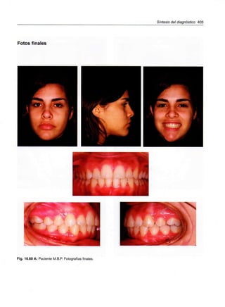 Síntesis del diagnóstico 405
Fotos finales
:,::-
Fig. 16.60 A: Paciente M.B.P. Fotografías finales.
 