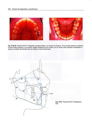 406 Síntesis del diagnóstico y planificación
Fig. 16.60 B: Paciente M.B.P. Fotografías oclusales finales, con estudio de simetría. En la arcada superior se observa
la línea media centrada y una posición sagital asimétrica de los molares, con el primer molar izquierdo mesializado el
espacio completo del premolar que se extrajo en dicha hemiarcada.
-1 mm
Fig. 16.61: Paciente M.B.P. Cefalograma
final.
 