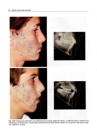 42 Estudio clínico del paciente
Fig. 1.39: Factores que intervienen en la definición de la posición sagital del mentón. La diferente forma y rotación de la
mandíbula y el mentón óseo, y las disímiles características del tejido blando influyen en la proyección que logra el pogo-
nion cutáneo en el perfil.
 