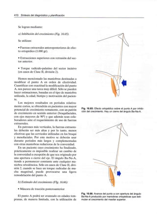 410 Síntesis del diagnóstico y planificación
Se logran mediante:
a) Inhibición del crecimiento (Fig. 16.65).
Se utilizan:
• Fuerzas extraorales anteroposteriores de efec-
to ortopédico (1.000 gr).
• Extracciones superiores con retrusión del sec-
tor anterior.
• Torque radículo-palatino del sector incisivo
(en casos de Clase II, división 2).
Hemos mencionado las maniobras destinadas a
modificar el punto A en orden de efectividad.
Cuantificar con exactitud la modificacióndel punto
A, nos parece una tarea muy difícil. Sólo se pueden
hacer estimaciones, basadas en el tipo de maniobra
utilizada, la edad, biotipo y motivación del pacien-
te.
Los mejores resultados en períodos relativa-
mente cortos, se obtendrán en pacientes con mayor
potencial de crecimiento remanente, con un patrón
de crecimiento en sentido anterior (braquifaciales,
con ejes mayores de 90°) y que además sean cola-
boradores ante el requerimiento de uso de fuerzas
extraorales.
En patrones más verticales, la fuerzas extraora-
les deberán ser más altas y por lo tanto, menos
efectivas que las cervicales utilizadas en los braqui
y mesofaciales. Por este motivo se deberán usar
durante períodos más largos y complementadas
con otras maniobras reductoras de la convexidad.
En un paciente cuyo crecimiento ha finalizado,
prácticamente es imposible realizar un cambio de
la convexidad a excepción de que sea originado por
una apertura o cierre del eje. El ángulo Ba-Na-A,
tiende a permanecer constante ante cualquier ma-
niobra ortodóncica. Sólo en casos de Clase II, divi-
sión 2, cuando se hace un torque radicular de mu-
cha magnitud, puede provocarse una ligera
remodelación del punto A.
b) Estímulo del crecimiento (Fig. 16.66):
• Máscara de tracción posteroanterior
El punto A podrá ser avanzado en edades tem-
pranas, de manera limitada, con la utilización de
Fig. 16.65: Efecto ortopédico sobre el punto A por inhibi-
ción del crecimiento. Hay un cierre del ángulo Ba-Na-A.
Fig. 16.66: Avance del punto a con apertura del ángulo
Ba-Na-A producido por maniobras ortopédicas que esti-
mulan el crecimiento del maxilar superior.
 
