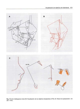 Visualización de objetivos de tratamiento 415
B
28'
2,5
Fig. 17.1: A: Cefalograma inicial. B: Visualización de los objetivos terapéuticos (VTO). C: Áreas de superposición (Ini-
cial - VTO).
 
