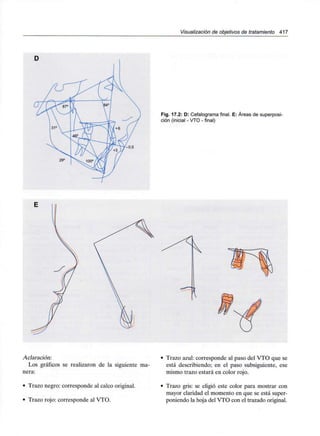 Visualizado/! de objetivos de tratamiento 417
D
29'
Fig. 17.2: D: Cefalograma final. E: Áreas de superposi-
ción (inicial - VTO - final)
Aclaración:
Los gráficos se realizaron de la siguiente ma-
nera:
• Trazo negro: corresponde al calco original.
• Trazo rojo: corresponde al VTO.
• Trazo azul: corresponde al paso del VTO que se
está describiendo; en el paso subsiguiente, ese
mismo trazo estará en color rojo.
• Trazo gris: se eligió este color para mostrar con
mayor claridad el momento en que se está super-
poniendo la hoja del VTO con el trazado original.
 