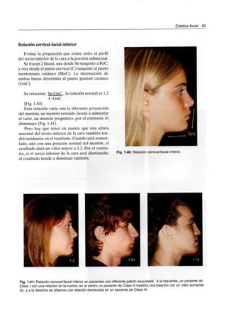 Estética facial 43
Relación cervical-facial inferior
Evalúa la proporción que existe entre el perfil
del tercio inferior de la cara y la porción submental.
Se trazan 2 líneas, una desde Sn tangente a PoC;
y otra desde el punto cervical (C) tangente al punto
mentoniano cutáneo (MeC). La intersección de
ambas líneas determina el punto gnation cutáneo
(GnC).
Se relaciona Sn-GnC , la relación normal es 1,2
C-GnC
(Fig. 1.40)
Esta relación varía con la diferente proyección
del mentón, un mentón retruido tiende a aumentar
el valor, un mentón prognático, por el contrario, lo
disminuye (Fig. 1.41).
Pero hay que tener en cuenta que una altura
anormal del tercio inferior de la cara también ten-
drá incidencia en el resultado. Cuando está aumen-
tado, aún con una posición normal del mentón, el
resultado dará un valor mayor a 1,2. Por el contra-
rio, si el tercio inferior de la cara está disminuido,
el resultado tiende a disminuir también.
Fig. 1.40: Relación cervical-facial inferior.
Fig. 1.41: Relación cervical-facial inferior en pacientes con diferente patrón esqueletal. Ala izquierda, un paciente de
Clase I con una relación en la norma, en el centro un paciente de Clase II muestra una relación con un valor aumenta-
do, y a la derecha se observa una relación disminuida en un paciente de Clase III.
 