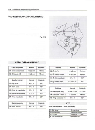 418 Síntesis del diagnóstico y planificación
VTO RESUMIDO CON CRECIMIENTO
Fig. 17.3.
CEFALOGRAMA BÁSICO
Clase esqueletal
01 - Convexidad facial
02 - Distancia A-B
Normal
+2 ± 2 mm
+4 ± 2 mm
Paciente
+9 mm
-13 mm
Maxilar inferior
03 - Eje facial
04 - Prof. facial
05 - Áng. pl. mandibular
06 - Altura facial inferior
07 - Arco mandibular
Normal
90° ± 3°
87° ± 3°
26° ± 4°
47° ± 4°
26° ± 4°
Paciente
85°
85°
34°
47°
26°
Maxilar superior
08 - Prof. maxilar
Normal
90° ± 3°
Paciente
94°
Dientes
09 - T - A-Po
10 - 1 - Plano oclusal
11 - 1 - Pl. mandibular
12-1- Plano BaNa
Normal
+1 ± 2 mm
+1 ± 1 mm
90° ± 5°
// E. Fac. -5°
Paciente
+7,5 mm
+1 mm
103°
90°
VTO
Con crecimiento a 2 años (resumido).
Estética
13 - Exposición del 1_
14 - Labio inf. - Plano E
15 - Áng. nasolabial Inf.
Normal
+2.5 a +3 mm
-2 ± 2 mm
85° ± 5°
Paciente
+3,5 mm
+4 mm
82°
1 - Eje facial
2 - Convexidad
3 - T-A-Po
4-T-PI. mandibular
Se mantiene
Disminuye 2 mm
Queda en +3,5 mm
Queda en 95°
 