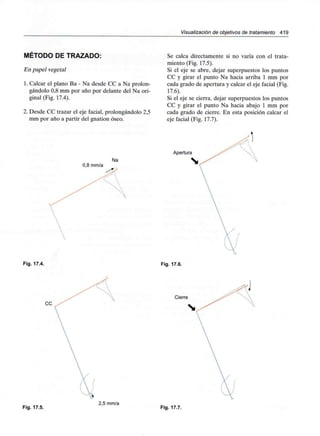 Visualización de objetivos de tratamiento 419
MÉTODO DE TRAZADO:
En papel vegetal
1. Calcar el plano Ba - Na desde CC a Na prolon-
gándolo 0,8 mm por año por delante del Na ori-
ginal (Fig. 17.4).
2. Desde CC trazar el eje facial, prolongándolo 2,5
mm por año a partir del gnation óseo.
0,8 mm/a
Na
Se calca directamente si no varía con el trata-
miento (Fig. 17.5).
Si el eje se abre, dejar superpuestos los puntos
CC y girar el punto Na hacia arriba 1 mm por
cada grado de apertura y calcar el eje facial (Fig.
17.6).
Si el eje se cierra, dejar superpuestos los puntos
CC y girar el punto Na hacia abajo 1 mm por
cada grado de cierre. En esta posición calcar el
eje facial (Fig. 17.7).
Apertura
Fig. 17.4. Fig. 17.6.
Cierre
CC
Fig. 17.5.
2,5 mm/a
Fig. 17.7.
 