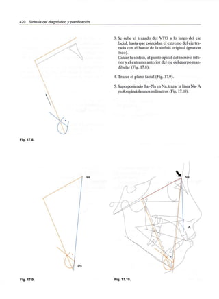 420 Síntesis del diagnóstico y planificación
3. Se sube el trazado del VTO a lo largo del eje
facial, hasta que coincidan el extremo del eje tra-
zado con el borde de la sínfisis original (gnation
óseo).
Calcar la sínfisis, el punto apical del incisivo infe-
rior y el extremo anterior del eje del cuerpo man-
dibular (Fig. 17.8).
4. Trazar el plano facial (Fig. 17.9).
5. Superponiendo Ba -Na en Na, trazar la línea Na- A
prolongándola unos milímetros (Fig. 17.10).
Fig. 17.8.
Na
Po
Fig. 17.9. Fig. 17.10.
 
