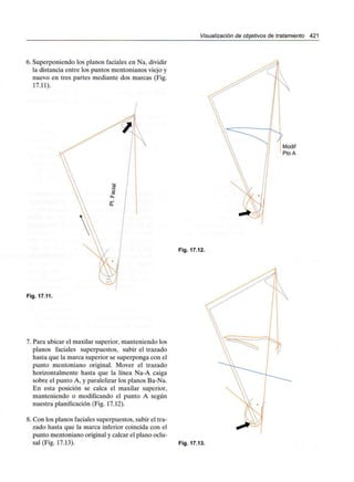 Visualización de objetivos de tratamiento 421
6. Superponiendo los planos faciales en Na, dividir
la distancia entre los puntos mentonianos viejo y
nuevo en tres partes mediante dos marcas (Fig.
17.11).
Modif
PtoA
Fig. 17.12.
Fig. 17.11.
7. Para ubicar el maxilar superior, manteniendo los
planos faciales superpuestos, subir el trazado
hasta que la marca superior se superponga con el
punto mentoniano original. Mover el trazado
horizontalmente hasta que la línea Na-A caiga
sobre el punto A, y paralelizar los planos Ba-Na.
En esta posición se calca el maxilar superior,
manteniendo o modificando el punto A según
nuestra planificación (Fig. 17.12).
8. Con los planos faciales superpuestos, subir el tra-
zado hasta que la marca inferior coincida con el
punto mentoniano original y calcar el plano oclu-
sal (Fig. 17.13). Fig. 17.13.
 