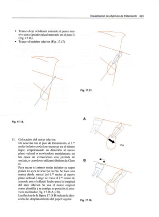 Visualización de objetivos de tratamiento 423
Trazar el eje del diente uniendo el punto inci-
sivo con el punto apical marcado en el paso 3.
(Fig. 17.16).
Trazar el incisivo inferior (Fig. 17.17).
Fig. 17.17.
Fig. 17.16.
11. Colocación del molar inferior:
De acuerdo con el plan de tratamiento, el l.er
molar inferior podrá permanecer en el mismo
lugar, erupcionando en dirección al nuevo
plano oclusal o moviéndose mesialmente en
los casos de extracciones con pérdida de
anclaje, o cuando se utilizan elásticos de Clase
II.
Para trazar el primer molar inferior se super
ponen los ejes del cuerpo en Pm. Se hace una
marca desde mesial del l.er molar al nuevo
plano oclusal. Luego se traza el l.er molar de
acuerdo con el cálculo hecho para la longitud
del arco inferior. Se usa el molar original
como plantilla y se corrige su posición si estu-
viera inclinado (Fig. 17.18 A y B).
Las flechas de la figura 17.18 B indican la dire-
cción del desplazamiento del papel vegetal.
B
Fig. 17.18.
 