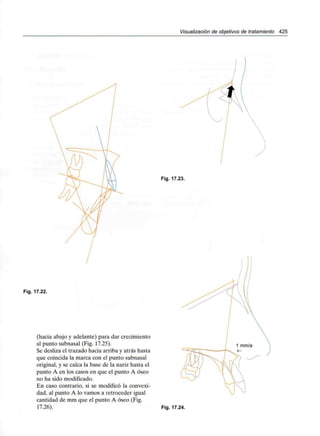 Visualización de objetivos de tratamiento 425
Fig. 17.23.
Fig. 17.22.
(hacia abajo y adelante) para dar crecimiento
al punto subnasal (Fig. 17.25).
Se desliza el trazado hacia arriba y atrás hasta
que coincida la marca con el punto subnasal
original, y se calca la base de la nariz hasta el
punto A en los casos en que el punto A óseo
no ha sido modificado.
En caso contrario, si se modificó la convexi-
dad, al punto A lo vamos a retroceder igual
cantidad de mm que el punto A óseo (Fig.
17.26). Fig. 17.24.
 