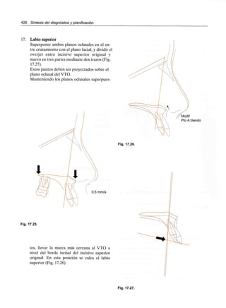 426 Síntesis del diagnóstico y planificación
17. Labio superior
Superponer ambos planos oclusales en el en-
tre cruzamiento con el plano facial, y dividir el
overjet entre incisivo superior original y
nuevo en tres partes mediante dos trazos (Fig.
17.27).
Estos puntos deben ser proyectados sobre el
plano oclusal del VTO.
Manteniendo los planos oclusales superpues-
0,5 mm/a
Fig. 17.25.
tos, llevar la marca más cercana al VTO a
nivel del borde incisal del incisivo superior
original. En esta posición se calca el labio
superior (Fig. 17.28).
Fig. 17.26.
Fig. 17.27.
 