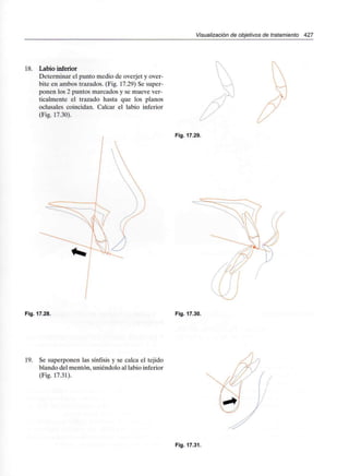 Visualizado/! de objetivos de tratamiento 427
18. Labio inferior
Determinar el punto medio de overjet y over-
bite en ambos trazados. (Fig. 17.29) Se super-
ponen los 2 puntos marcados y se mueve ver-
ticalmente el trazado hasta que los planos
oclusales coincidan. Calcar el labio inferior
(Fig. 17.30).
Fig. 17.29.
Fig. 17.28. Fig. 17.30.
19. Se superponen las sínfisis y se calca el tejido
blando del mentón, uniéndolo al labio inferior
(Fig. 17.31).
Fig. 17.31.
 