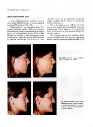 44 Estudio clínico del paciente
Inclinación del filtrum labial
En el perfil del paciente, también se hará la
observación del labio superior en sonrisa, especial-
mente del filtrum labial (Fig. 1.42).
Esto permite tener una apreciación clínica de la
posición sagital del maxilar y de los incisivos supe-
riores, que con labios relajados puede estar enmas-
carada por características propias de los tejidos
blandos. Por ejemplo, en pacientes de escaso desa-
rrollo vertical y sagital del maxilar, el labio superior
se presenta evertido por falta de soporte y esta
situación puede dar una apariencia normal del
ángulo nasolabial inferior cuando el paciente está
con labios en reposo.
Pero en la sonrisa se hace evidente esta retru-
sión porque a causa de la contracción provocada
por la sonrisa, el labio superior se apoya firmemen-
te en los incisivos y la parte anterior del reborde
alveolar superior.
Como consecuencia de esto, el filtrum labial
asume una inclinación muy marcada hacia atrás,
desfavoreciendo la estética de la sonrisa (Fig. 1.43).
Fig. 1.42: Inclinación normal del filtrum
labial en reposo y en sonrisa.
Fig. 1.43: Paciente de Clase III con
hipodesarrollo del maxilar superior.
La observación del perfil en sonrisa
pone en evidencia la necesidad de
un avance maxilar.
 
