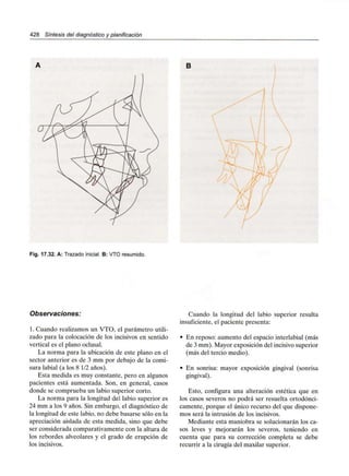 428 Síntesis del diagnóstico y planificación
B
Fig. 17.32. A: Trazado inicial. B: VTO resumido.
Observaciones:
1. Cuando realizamos un VTO, el parámetro utili-
zado para la colocación de los incisivos en sentido
vertical es el plano oclusal.
La norma para la ubicación de este plano en el
sector anterior es de 3 mm por debajo de la comi-
sura labial (a los 8 1/2años).
Esta medida es muy constante, pero en algunos
pacientes está aumentada. Son, en general, casos
donde se comprueba un labio superior corto.
La norma para la longitud del labio superior es
24 mm a los 9 años. Sin embargo, el diagnóstico de
la longitud de este labio, no debe basarse sólo en la
apreciación aislada de esta medida, sino que debe
ser considerada comparativamente con la altura de
los rebordes alveolares y el grado de erupción de
los incisivos.
Cuando la longitud del labio superior resulta
insuficiente, el paciente presenta:
• En reposo: aumento del espacio interlabial (más
de 3 mm).Mayor exposición del incisivo superior
(más del tercio medio).
• En sonrisa: mayor exposición gingival (sonrisa
gingival).
Esto, configura una alteración estética que en
los casos severos no podrá ser resuelta ortodónci-
camente, porque el único recurso del que dispone-
mos será la intrusión de los incisivos.
Mediante esta maniobra se solucionarán los ca-
sos leves y mejorarán los severos, teniendo en
cuenta que para su corrección completa se debe
recurrir a la cirugía del maxilar superior.
 