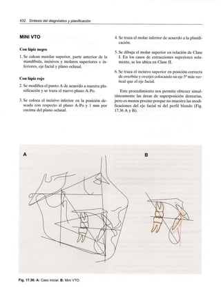 432 Síntesis del diagnóstico y planificación
MINI VTO
Con lápiz negro
1. Se calcan maxilar superior, parte anterior de la
mandíbula, incisivos y molares superiores e in-
feriores, eje facial y plano oclusal.
Con lápiz rojo
2. Se modifica el punto A de acuerdo a nuestra pla-
nificación y se traza el nuevo plano A-Po.
3. Se coloca el incisivo inferior en la posición de-
seada con respecto al plano A-Po y 1 mm por
encima del plano oclusal.
4. Se traza el molar inferior de acuerdo a la planifi-
cación.
5. Se dibuja el molar superior en relación de Clase
I. En los casos de extracciones superiores sola-
mente, se los ubica en Clase II.
6. Se traza el incisivo superior en posición correcta
de overbite y overjet colocando su eje 5°más ver-
tical que el eje facial.
Este procedimiento nos permite obtener simul-
táneamente las áreas de superposición dentarias,
pero es menos preciso porque no muestra las modi-
ficaciones del eje facial ni del perfil blando (Fig.
17.36 A y B).
B
Fig. 17.36: A: Caso inicial. B: Mini VTO.
 