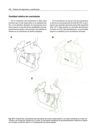 436 Síntesis del diagnóstico y planificación
Cantidad relativa de crecimiento
En la evaluación del crecimiento se debe tener
presente que lo más importante es su cantidad rela-
tiva, no la absoluta. Ejemplo: los incrementos de la
base craneal y el eje del cuerpo mandibular son com-
parativamente iguales. Esto permite una relación ar-
mónica en el crecimiento de ambos maxilares.
Si el crecimiento de una de esas dos estructuras
se desvía en una proporción de más del 50% se pro-
ducirá una marcada alteración del perfil esqueletal
(Fig. 18.7). Sólo pueden ser toleradas desviaciones
de hasta un 20% aproximadamente, un porcentaje
mayor se considera ya un crecimiento anormal.
Fig, 18.7: Paciente MC. Comparación del crecimiento de la base craneal anterior y el cuerpo mandibular en 6 años. A:
Trazado a los 9 años. B: Trazado a los 15 años. El crecimiento mandibular fue aproximadamente el doble de lo espera-
do y produjo un perfil de Clase III. C: Superposición de ambos trazados.
 