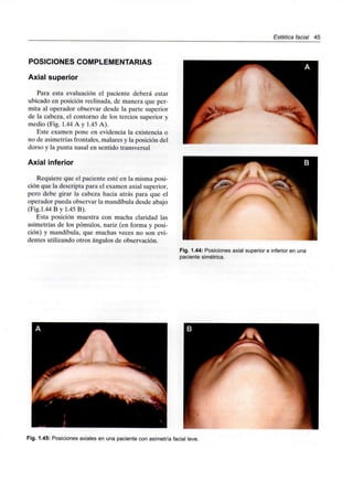 Estética facial 45
POSICIONES COMPLEMENTARIAS
Axial superior
Para esta evaluación el paciente deberá estar
ubicado en posición reclinada, de manera que per-
mita al operador observar desde la parte superior
de la cabeza, el contorno de los tercios superior y
medio (Fig. 1.44 A y 1.45 A).
Este examen pone en evidencia la existencia o
no de asimetrías frontales, malares y la posición del
dorso y la punta nasal en sentido transversal
Axial inferior
Requiere que el paciente esté en la misma posi-
ción que la descripta para el examen axial superior,
pero debe girar la cabeza hacia atrás para que el
operador pueda observar la mandíbula desde abajo
(Fig.1.44 B y 1.45 B).
Esta posición muestra con mucha claridad las
asimetrías de los pómulos, nariz (en forma y posi-
ción) y mandíbula, que muchas veces no son evi-
dentes utilizando otros ángulos de observación.
Fig. 1.44: Posiciones axial superior e inferior en una
paciente simétrica.
Fig. 1.45: Posiciones axiales en una paciente con asimetría facial leve.
 